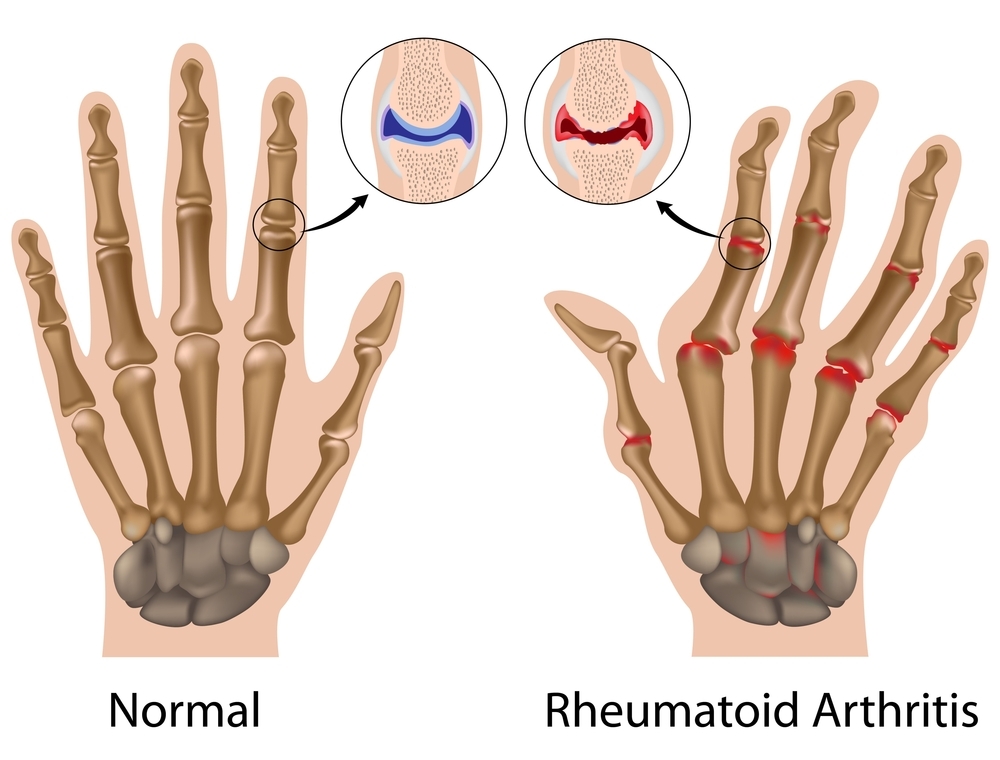image of hands, in x-ray view, showing normal bones and joints vs bones and joints damaged by rheumatoid arthritis