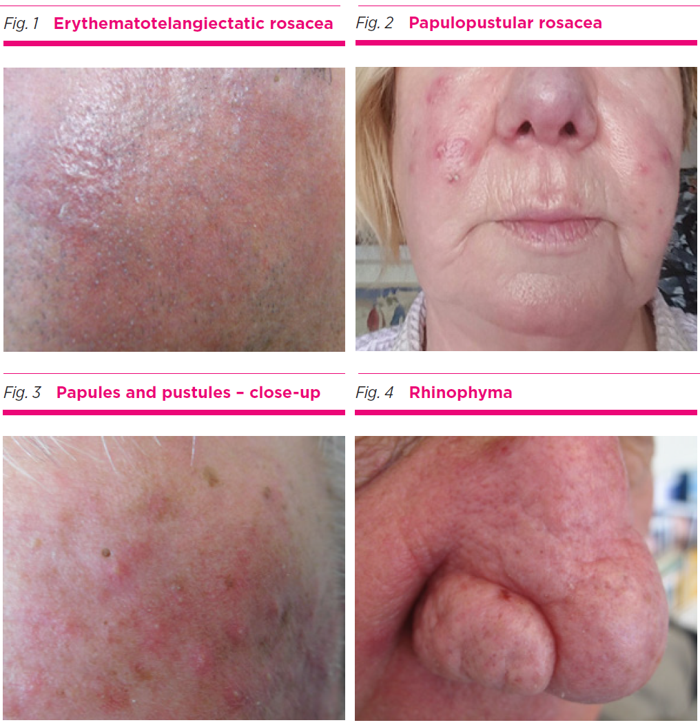 Rosacea types