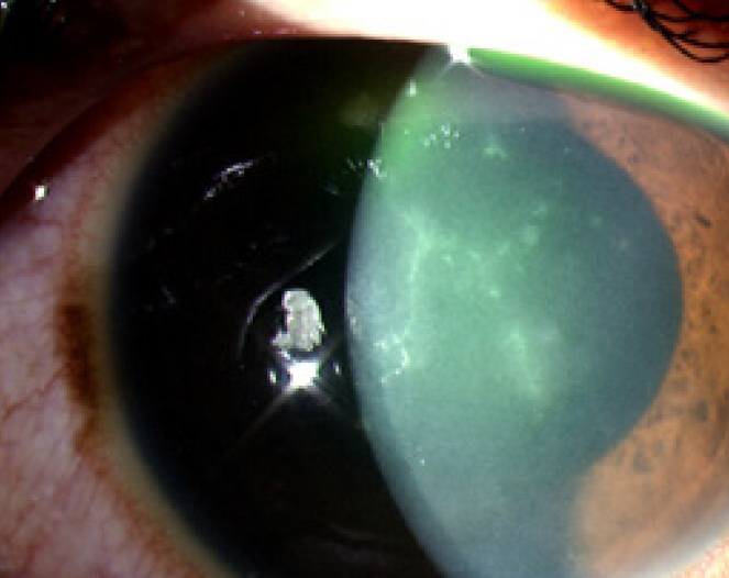 Common Eye Infections Australian Prescriber