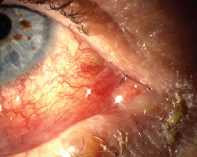 Common Eye Infections Nps Medicinewise