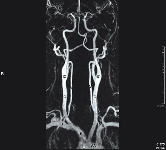 A contrast-enhanced magnetic resonance angiogram of the arterial supply to the brain