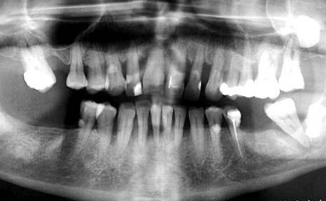 Alveolar bone loss