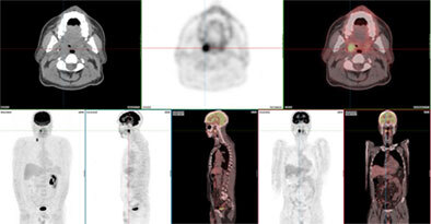 Diagnosing occult primary malignancy using FDG-PET