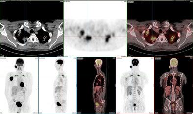 Diagnostic FDG-PET scan