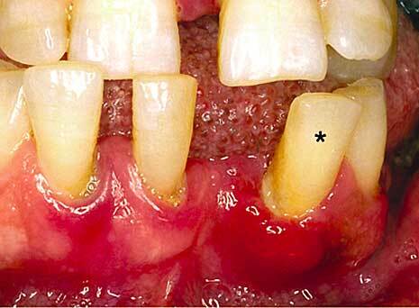 Periodontal abscess formation