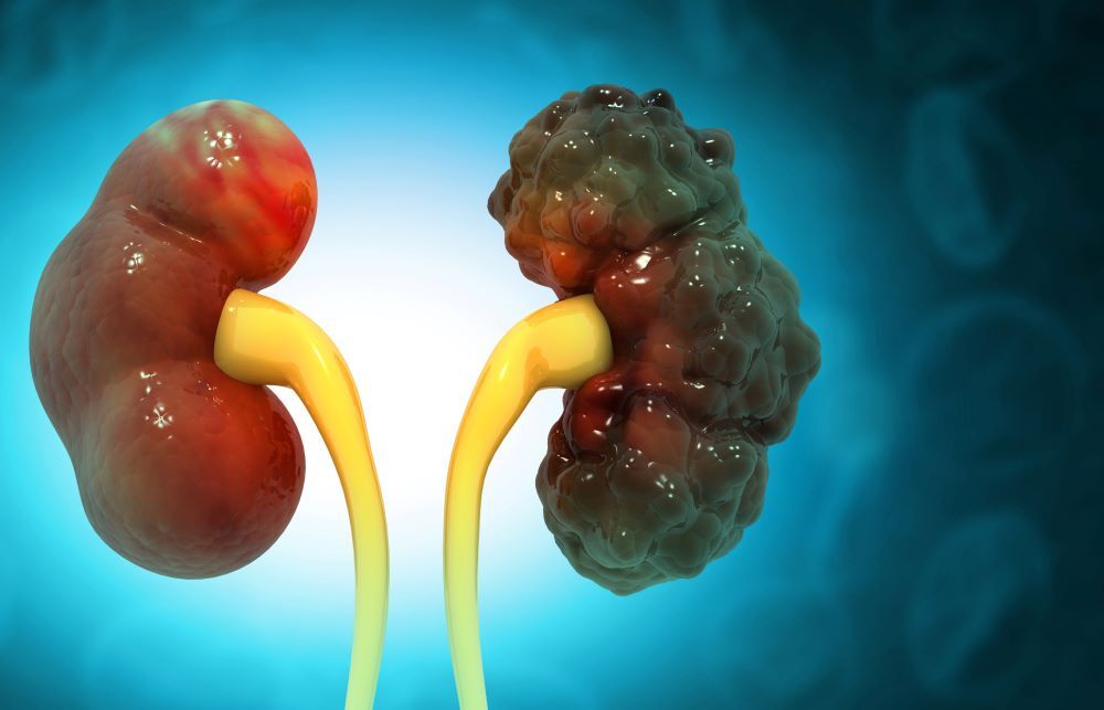 Drug management of autosomal dominant polycystic kidney disease