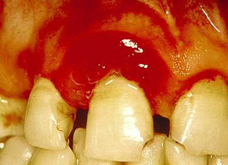 Diabetes and periodontitis