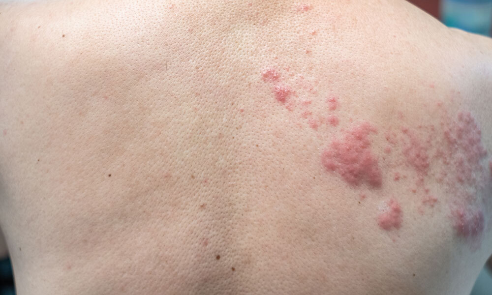 New shingles vaccine