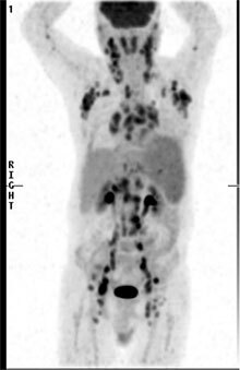 Staging of Hodgkin's lymphoma using FDG-PET