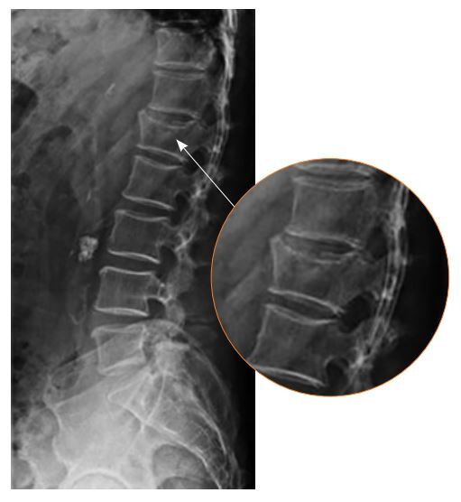 Image of compression fracture of L1 vertebra