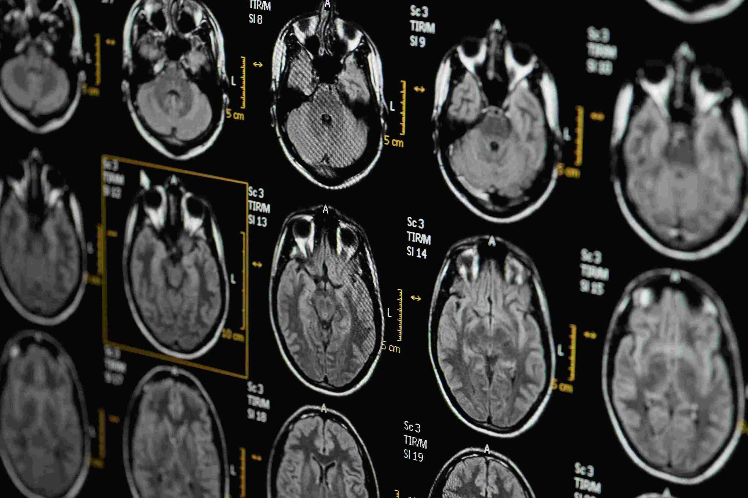 MRI Image of head