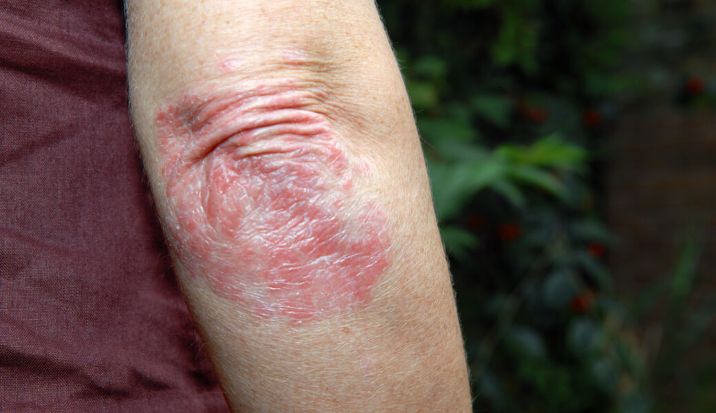 Treatments for plaque psoriasis Dermatology