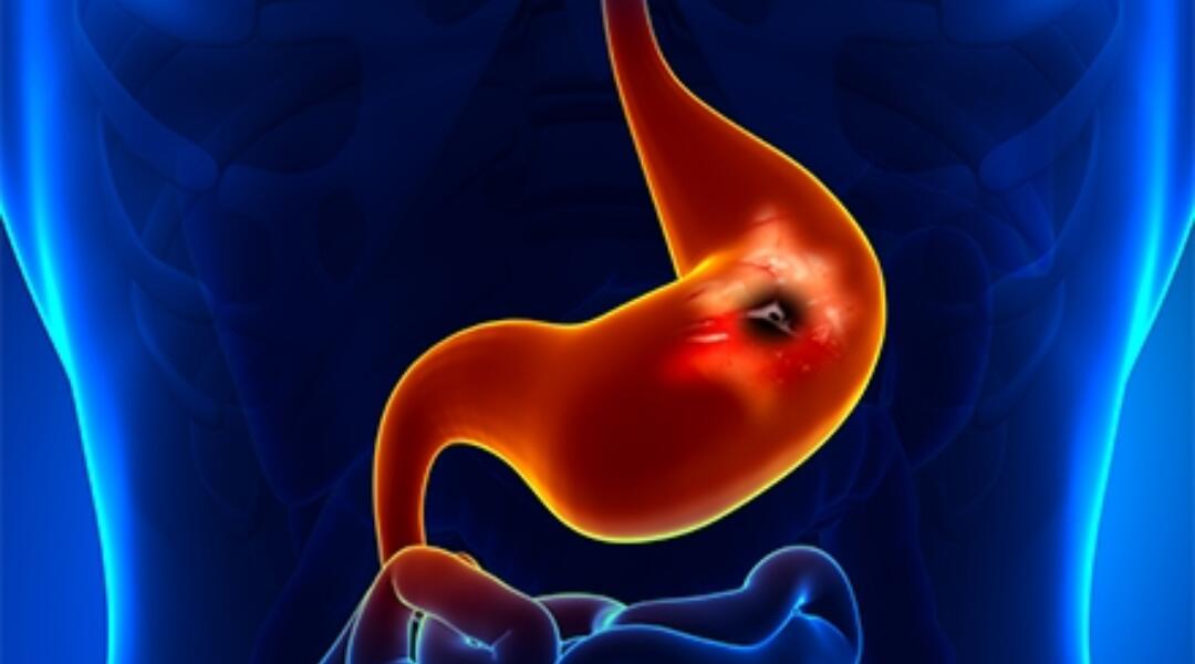 0Cea7Bb9Eb6590E6 F5Ed2D3Db55D Peptic Ulcer 440