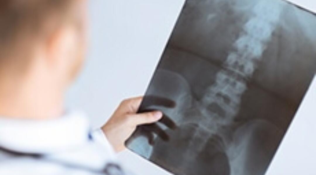 Osteoporosis: not just a women's disease