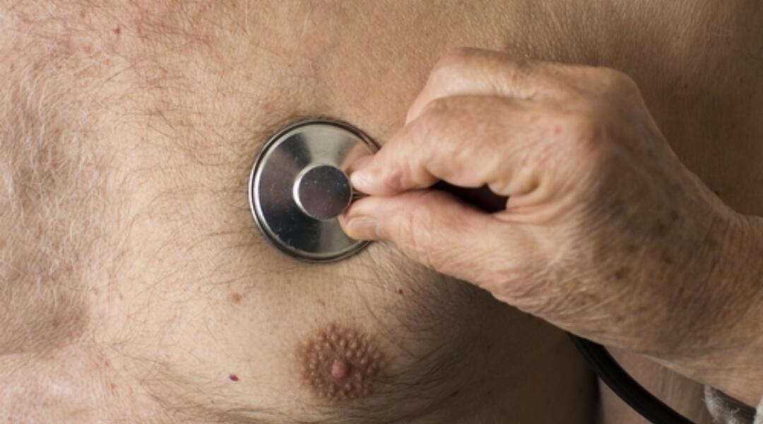 Acute pulmonary oedema in CHF