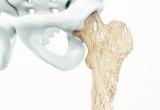 69F1B6652C523541 109Ef85Cb98C Osteoporotic Hip Shutterstock 524340781
