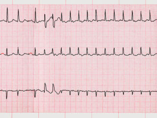 Atrial fibrillation: an update on management