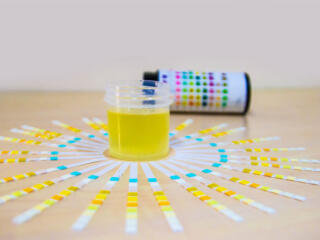 Management of proteinuria: blockade of the renin–angiotensin–aldosterone system