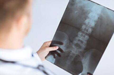 Osteoporosis: not just a women's disease