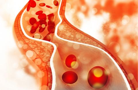 Statins revisited – appropriate patient selection and management are key