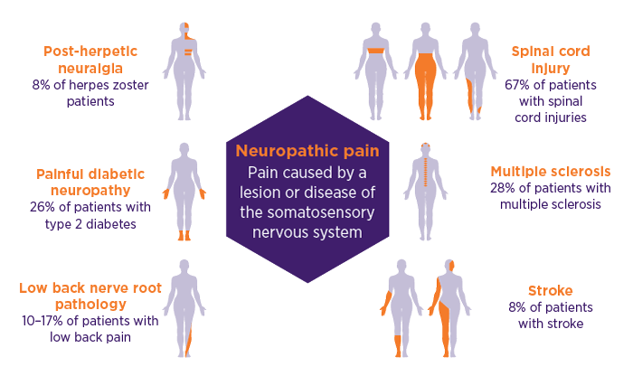 Neuropathic Pain Diagnosis And Treatment Today Nps Medicinewise